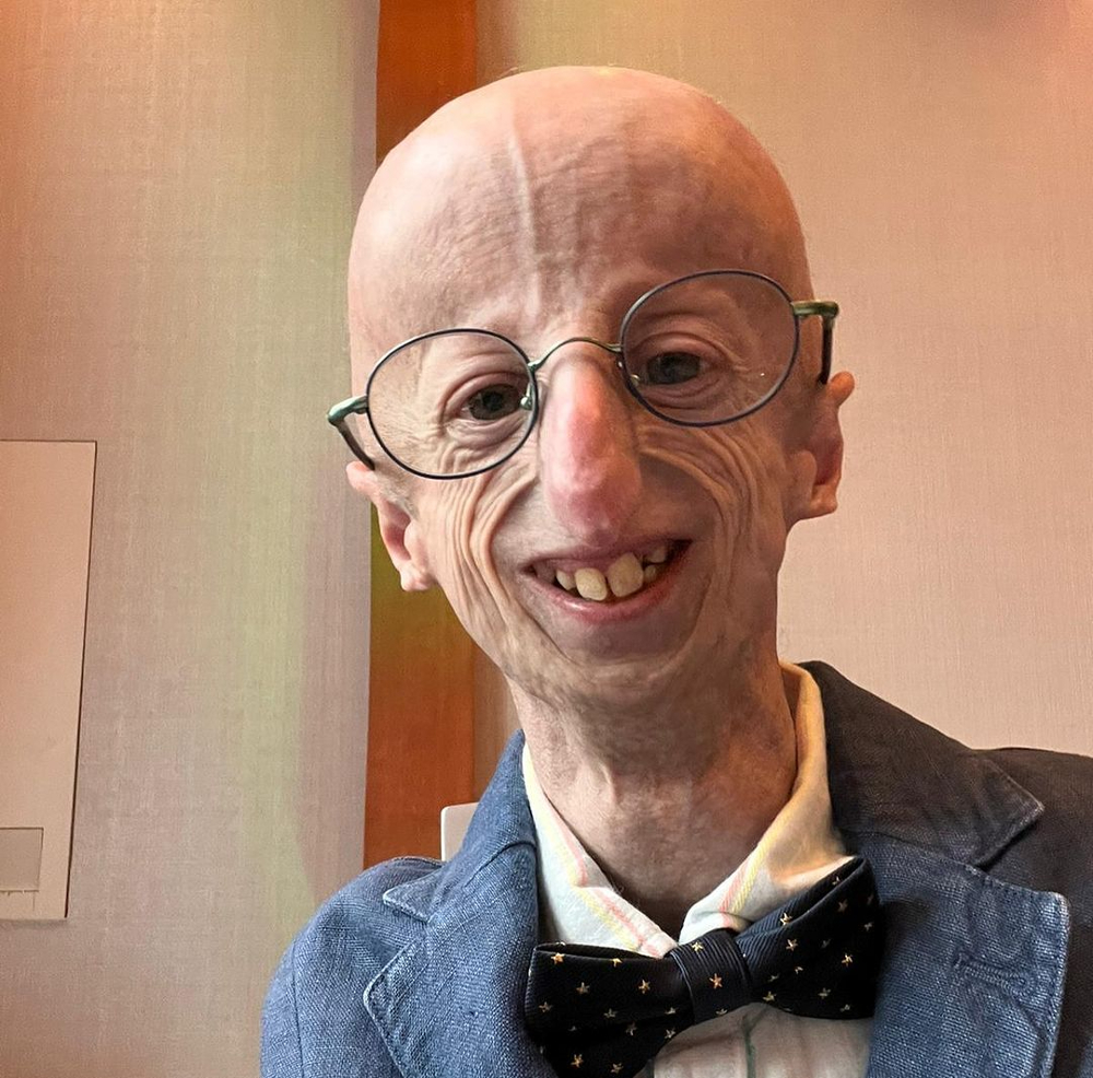 Pengidap, aktivis, sekaligus peneliti progeria Sammy Basso meninggal dunia. (Foto/instagram @sammybasso)