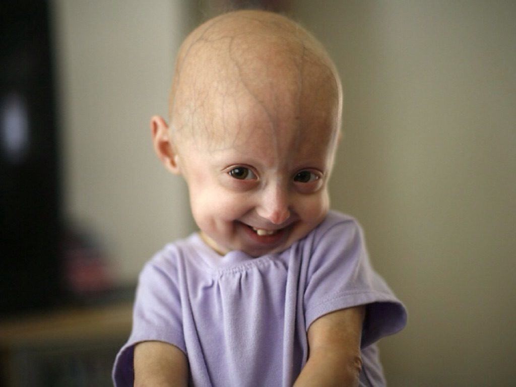 Menggenal penyakit progeria. (Foto/Ist)