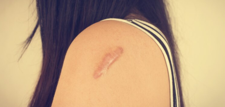 Ilustrasi keloid. (Foto/Freepik)