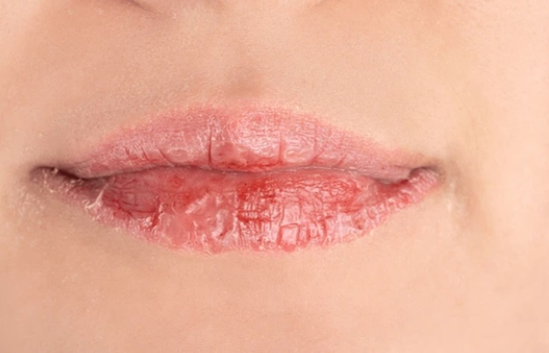 Bibir kering dan pecah-pecah (Foto/Shutterstock)