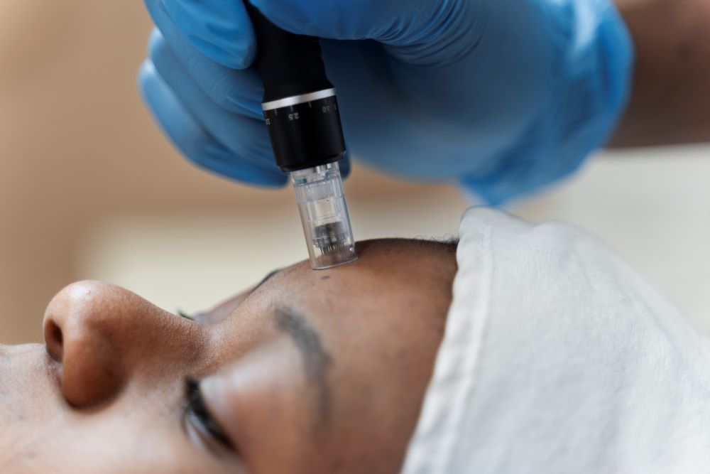 Ilustrasi perawatan dengan teknik microneedling. (Foto/Freepik)