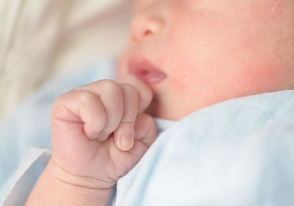 Ilustrasi bayi mengalami eczema akut. (Foto/Freepik)