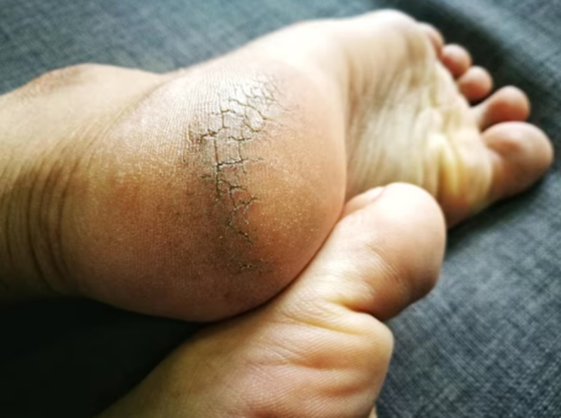 Kulit kaki pecah-pecah (Foto/Freepik)