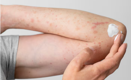 Ilustrasi ruam kulit (BeritaNasional/Freepik)