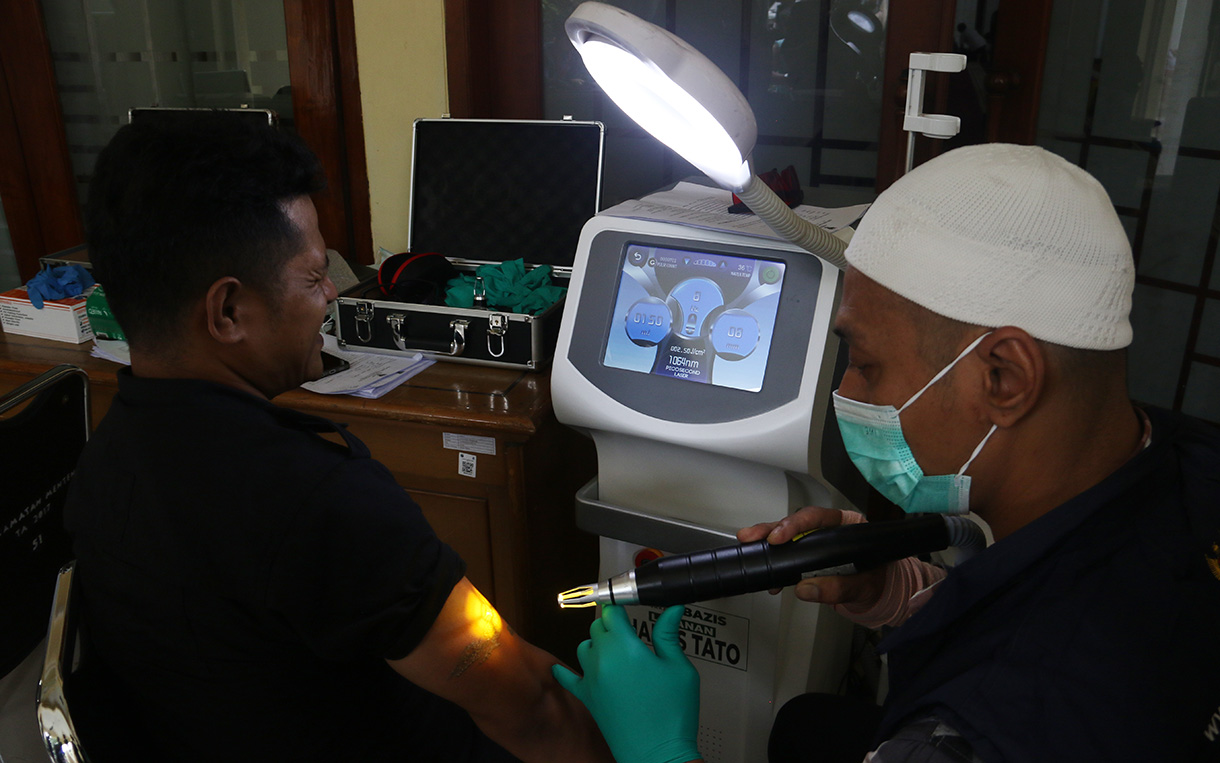 Petugas medis menghapus tato peserta menggunakan laser di Masjid Sunda Kelapa, Jakarta, Selasa(24/2/2026).  (Beritanasional.com/Oke Atmaja)
