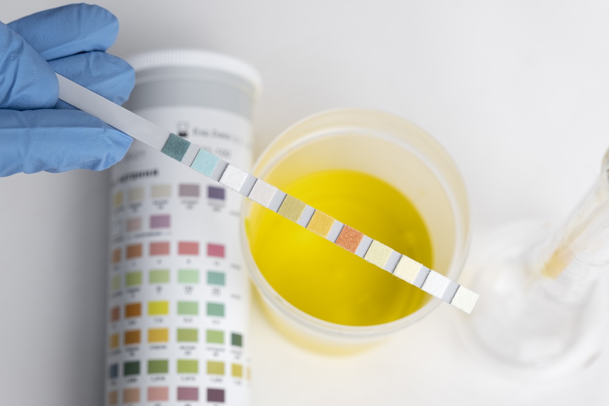 Ilustrasi test urine. (Foto/freepik)
